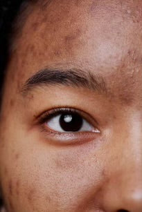 Comment éliminer ses tâches pigmentaires||