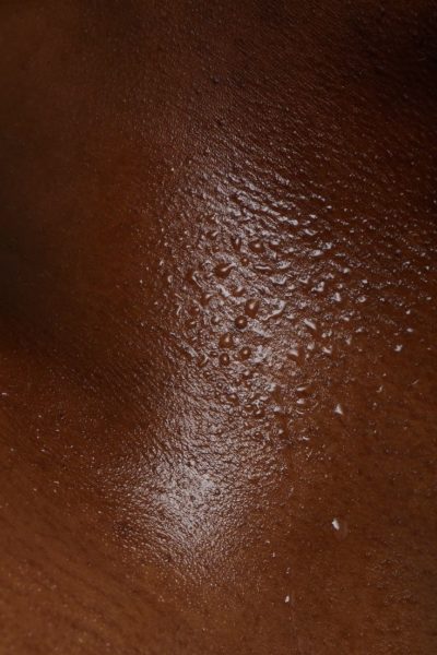 bouton de chaleur que faire ?