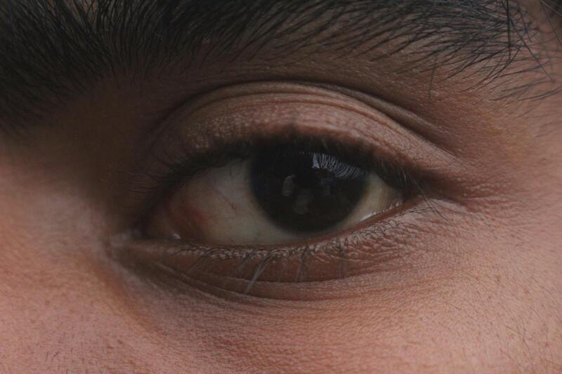 Cernes : Causes, Types et Traitements